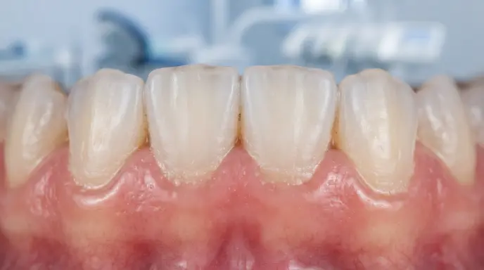 Dental_plaque_buildup_illustration